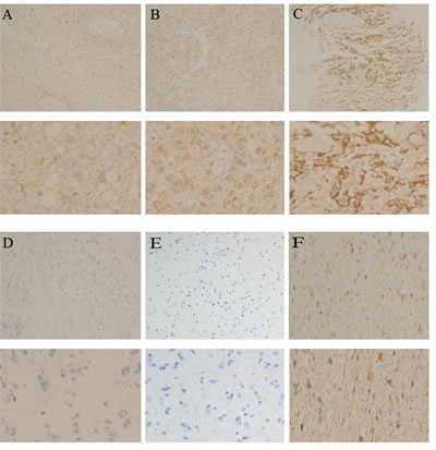 The expression pattern of PD-L1 in gliomas.