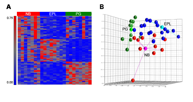 Nanostring classifier designates transcriptional subclasses of astrocytic LGG.