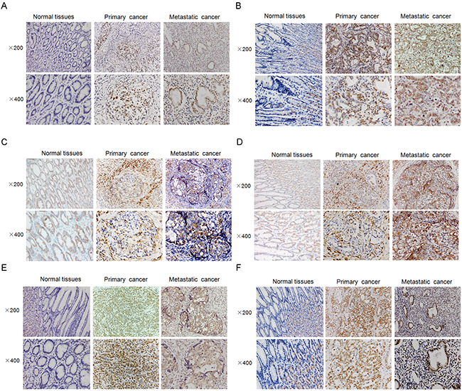 Representative figures of several CSC-related markers or proteins in, gastric tumors, its surrounding normal tissues and paired metastatic cancer samples.