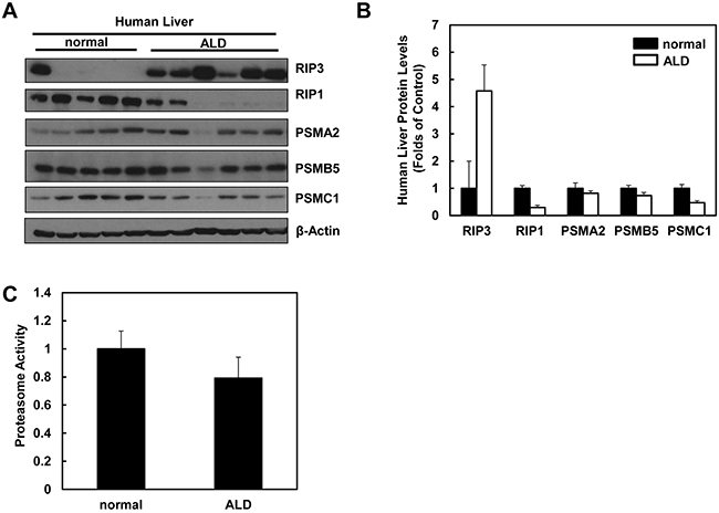 Human ALD livers have altered protein levels of RIP1, RIP3 and proteasome subunit proteins compared to healthy human livers.