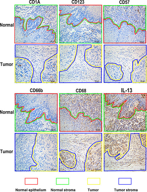 Representative images of different immune markers&#x2019; distribution in ESCC tissues detected with IHC staining.