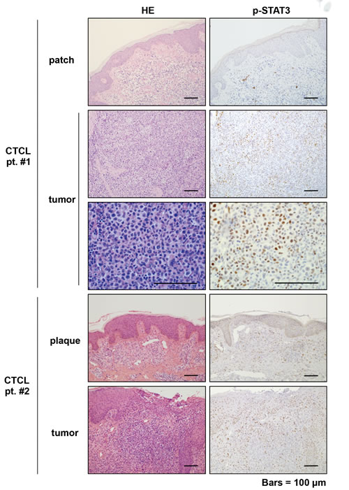 Immunohistochemical analysis of p-STAT3 in early and advanced mycosis fungoides.