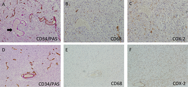 Immunohistochemistry of VM and macrophages in GBM samples.