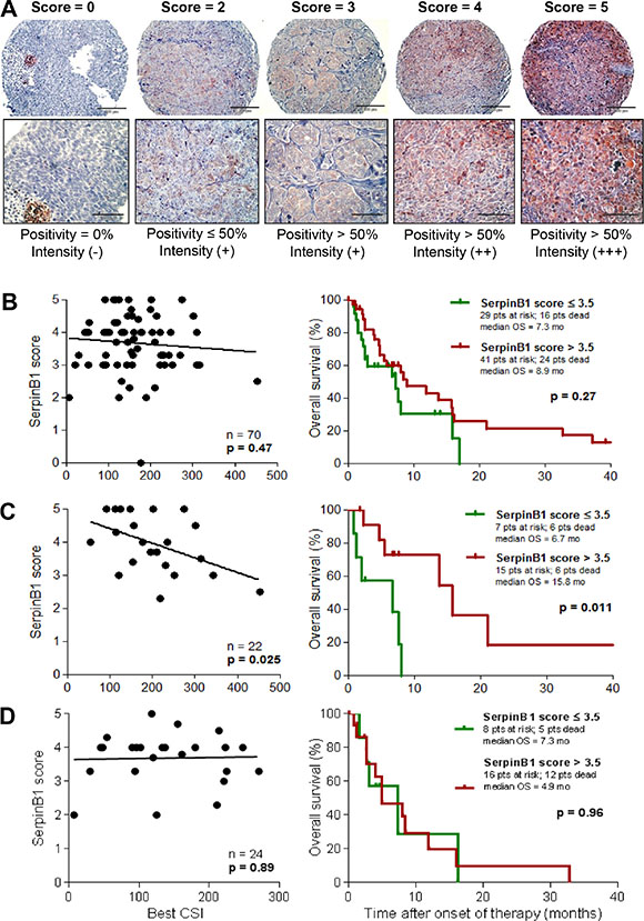 SERPINB1 protein expression in melanoma tissues correlates with in vitro and in vivo sensitivity to cisplatin-based chemotherapy.
