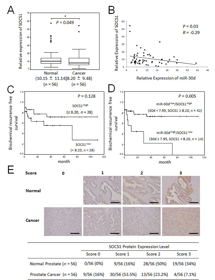 The relationship between miR-30d and SOCS1 expression are associated with early biochemical recurrence.