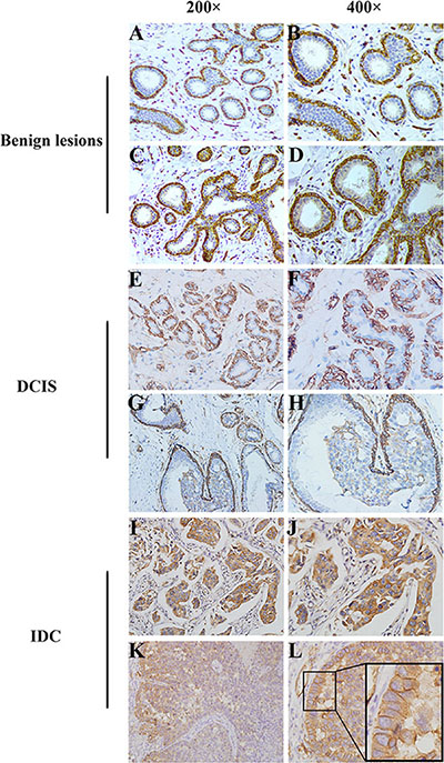 Distinct cellular localization of AQP1 was detected in different breast tissues.