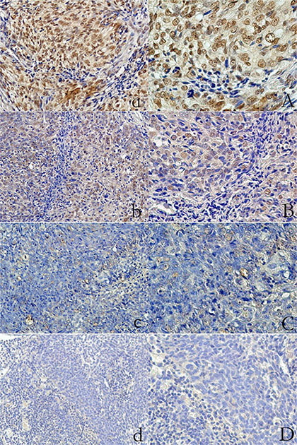 Expression of LOX in primary nasopharyngeal carcinoma (IHC staining) Strong expression.