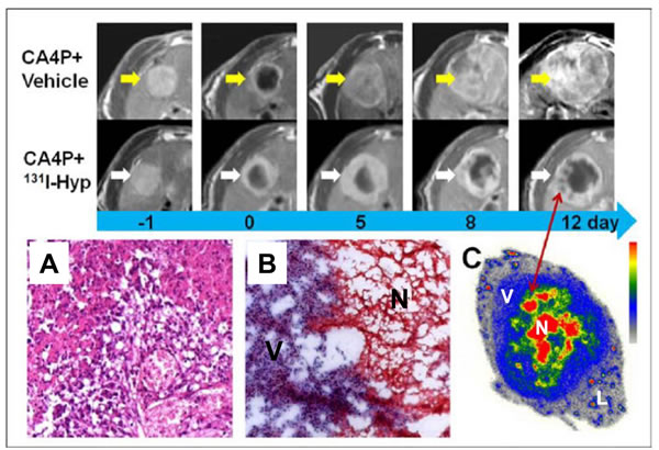 CA4P in combination with necrosis-targeted radiotherapy with
