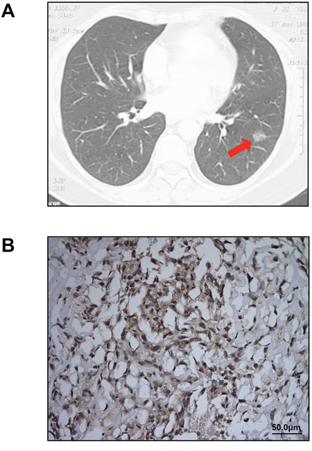 Clinical diagnosis of lung adenocarcinoma and MPM.