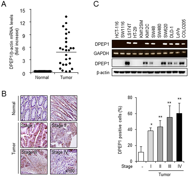 DPEP1 expression in colon cancer tissue and cell lines.