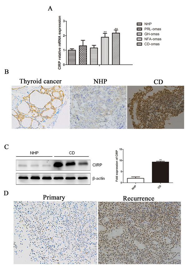 Human corticotroph adenoma shower higher CIRP expression.