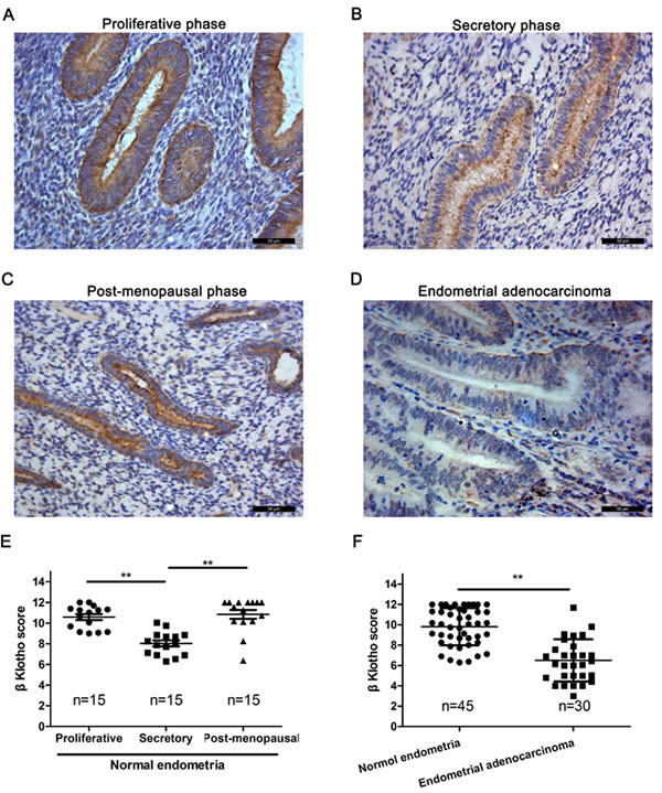 &#x3b2;Klotho expression is decreased in human endometrial adenocarcinomas.