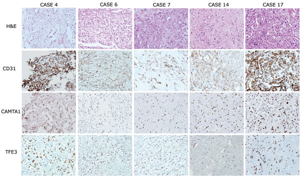 Histological features and immunohistochemical expression profiles of TFE3-positive EHEs.