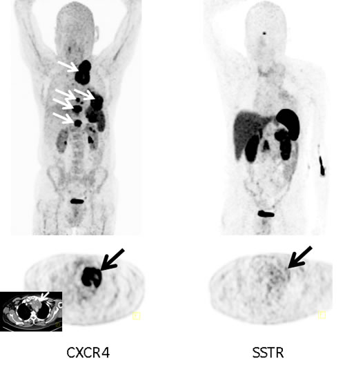 Example of a CXCR4-positive, SSTR-negative SCLC patient.