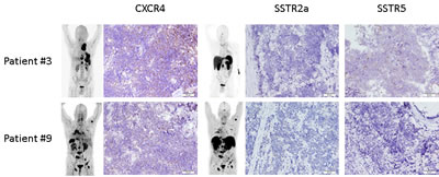 Immunohistochemical expression of CXCR4 and somatostatin receptors 2a and 5 in SCLC.