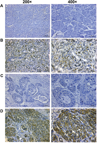 Immunohistochemical detection of BMI-1 and CD133 expression in pancreatic cancer tissues.