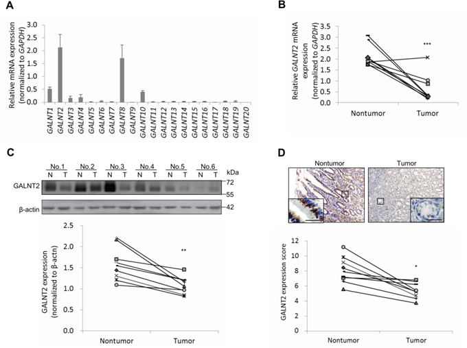 Expression of GALNT2 in human gastric cancers and non-tumorous mucosa.