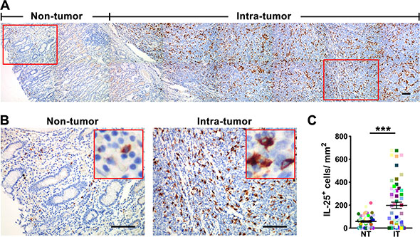 IL-25+ cells are enriched in the tumor tissue in gastric cancer.