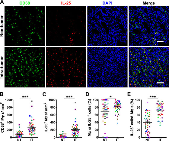 The majority of IL-25-expressing cells are produced in M&#x03C6;s in human gastric cancer tissue.