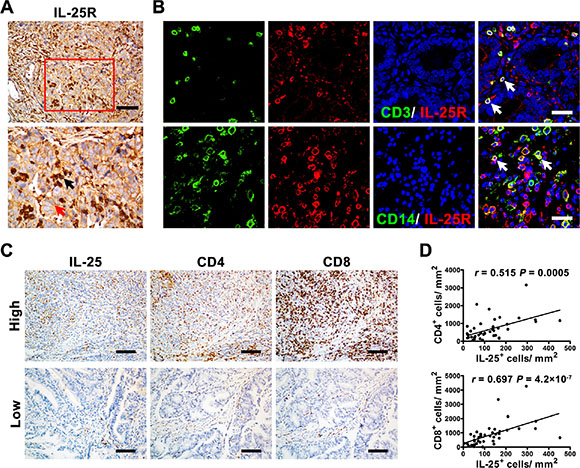 IL-25+ cells were positively associated with effector immune cells in gastric cancer tissue.