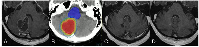 Selected case of large brain metastases treated with hypofractionated stereotactic radiation.