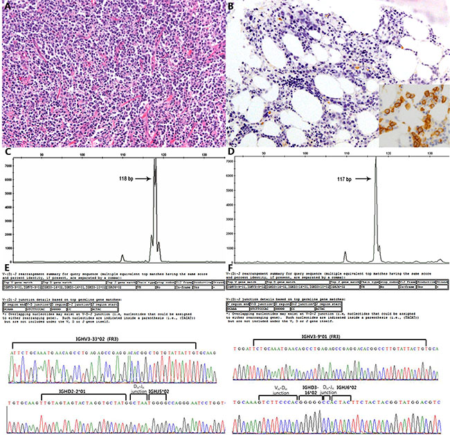 Representative case (#17) of an unrelated relapse from a DLBCL to a DLBCL.