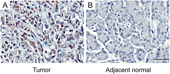 Immunohistochemical staining for EZH2 expression in pancreatic cancer tissues and adjacent normal tissuesRepresentative figures of EZH2 expression in pancreatic cancer tissues and adjacent normal tissues.
