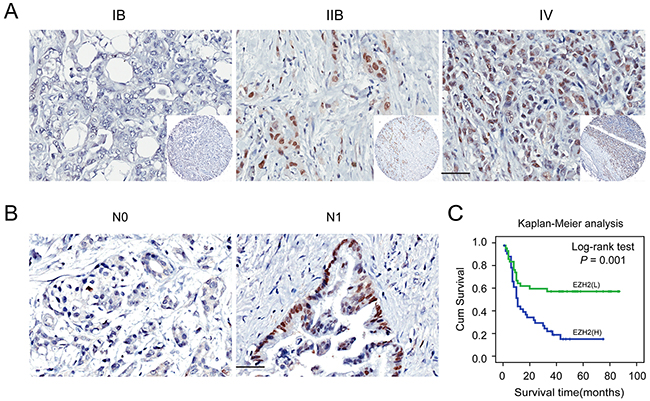 Immunohistochemical staining for EZH2 protein expression with or without lymph nodes metastasis and with different clinical stages of pancreatic cancer.