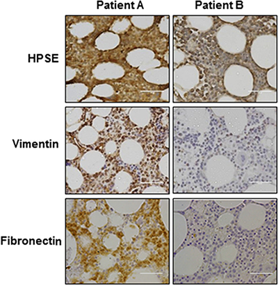Heparanase expression is positively correlated with expression of vimentin and fibronectin in myeloma patient cells.