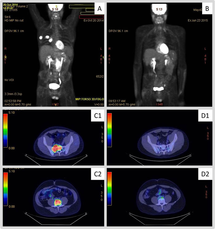 18F-fluorodeoxy-glucose&#x2013;positron-emission tomography (FDG-PET) images obtained to evaluate response to therapy with pembrolizumab.