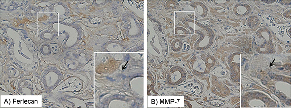 Perlecan and MMP-7 stain expression intersect in tissue microarray.