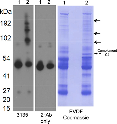 Western blot and protein stain of normal and stage IV prostate cancer sera.