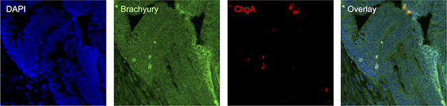 Immuno-detection of Brachyury and ChgA in poorly differentiated pT3N0 adenocarcinoma CRC tissue.