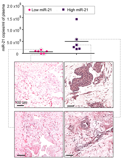 Circulating miR-21 expression reflects expression of miR-21 in tumour tissue.
