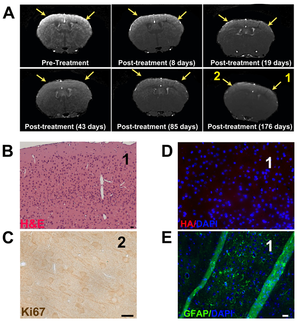 Pen-d/n-ATF5-RP promotes rapid and long-term regression/eradication of mouse glioma as indicated by MRI and histology.