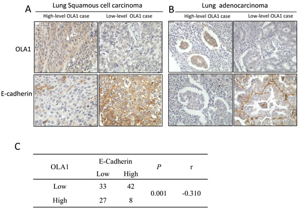 IHC analysis of OLA1 and E-cadherin expression in human lung cancer tissues.