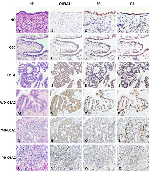 Expression of Olfactomedin 4 (OLFM4), estrogen receptor-a (ER&#x3b1;) and progesterone receptor (PR) in normal ovary (NO); ovarian serous cystadenoma (OSC); ovarian serous borderline tumor (OSBT); well-differentiated ovarian serous adenocarcinoma (WD-OSAC), moderately-differentiated ovarian serous adenocarcinoma (MD-OSAC) and poorly-differentiated ovarian serous adenocarcinoma (PD-OSAC) detected by immunohistochemistry.