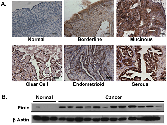 Pinin expression in clinical ovarian specimens and ovarian cell lines.