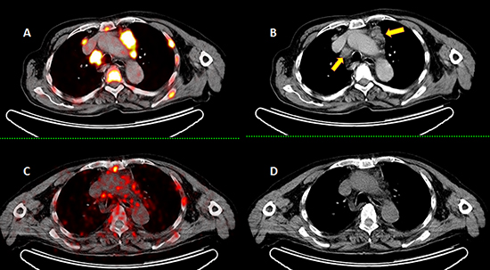 Ga-PSMA PET images A&#x0026;B. of a 72-year-old patient with diffuse bone and lymph node metastases (yellow arrows show the enlarged lymph nodes) received two cycles of Lu-PSMA.