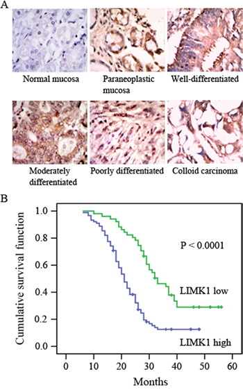 LIMK1 expression is correlated with survival probability.