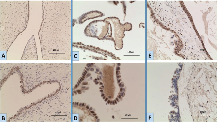 Expression of EGFR by immunohistochemistry in ovarian tumours