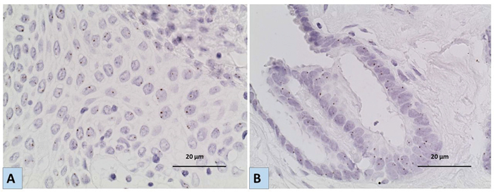 Representative images for the results of Chromogenic In situ hybridization (CISH) using EGFR specific probe