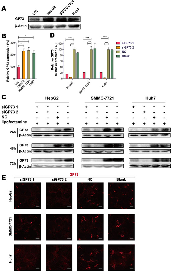 GP73 is highly expressed in HCC cells, and siGP73 downregulated GP73 expression in vitro.