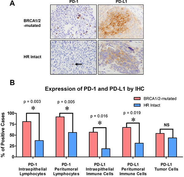 PD-1 and PD-L1 expression in the intraepithelial and peritumoral immune cells of BRCA1/2-mutated versus HR-proficient tumors.