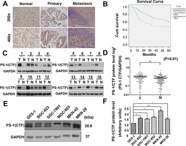 Upregulation of PS-1(CTF) correlates with poor prognosis in human GC.