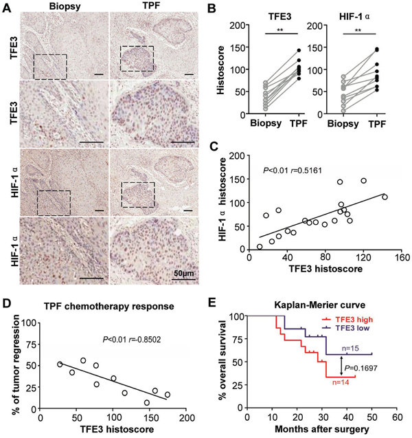 Increased TFE3 correlated with hypoxia in cisplatin- based chemotherapy.