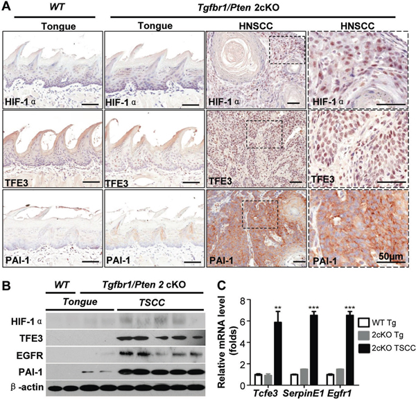 TFE3 upregulation is correlated with HIF-1&#x03B1; and PAI-1 in Tgfbr1/Pten 2cKO mice bearing spontaneously developed HNSCC tumors.