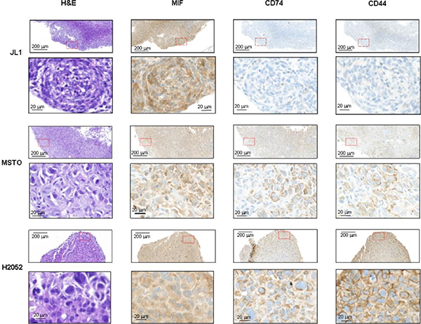 MIF, CD74 and CD44 expressions in intra-pleural human mesothelioma.