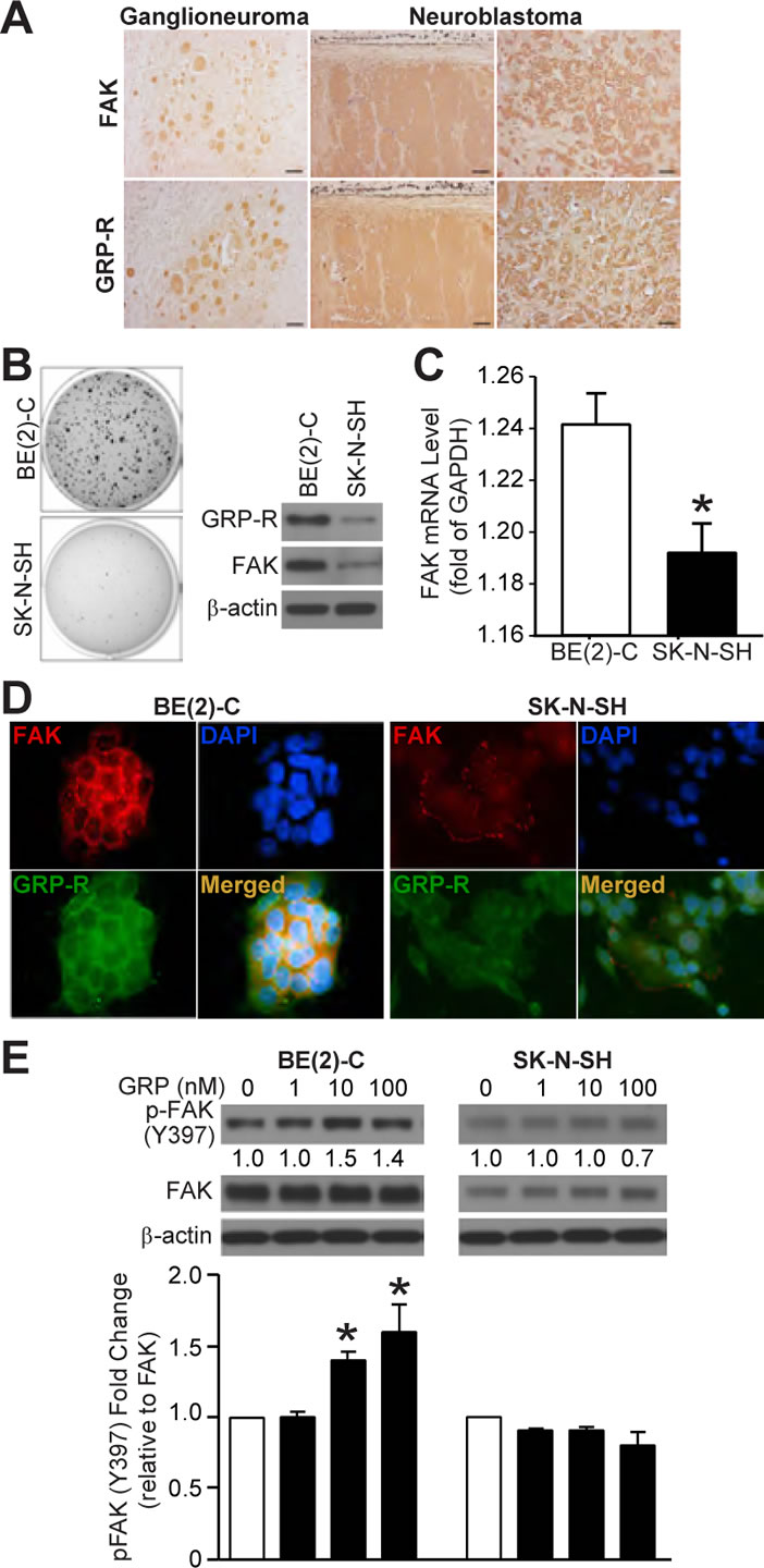 GRP-R and FAK expressions correlate to neuroblastoma malignancy and GRP-induced FAK activation (Y397).