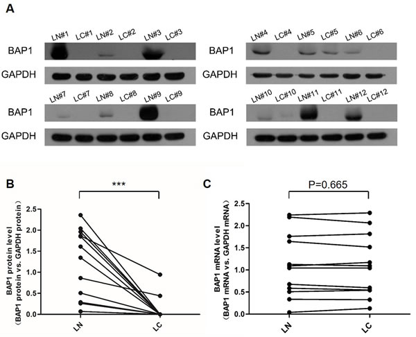Expression patterns of BAP1 in human lung cancer tissues.